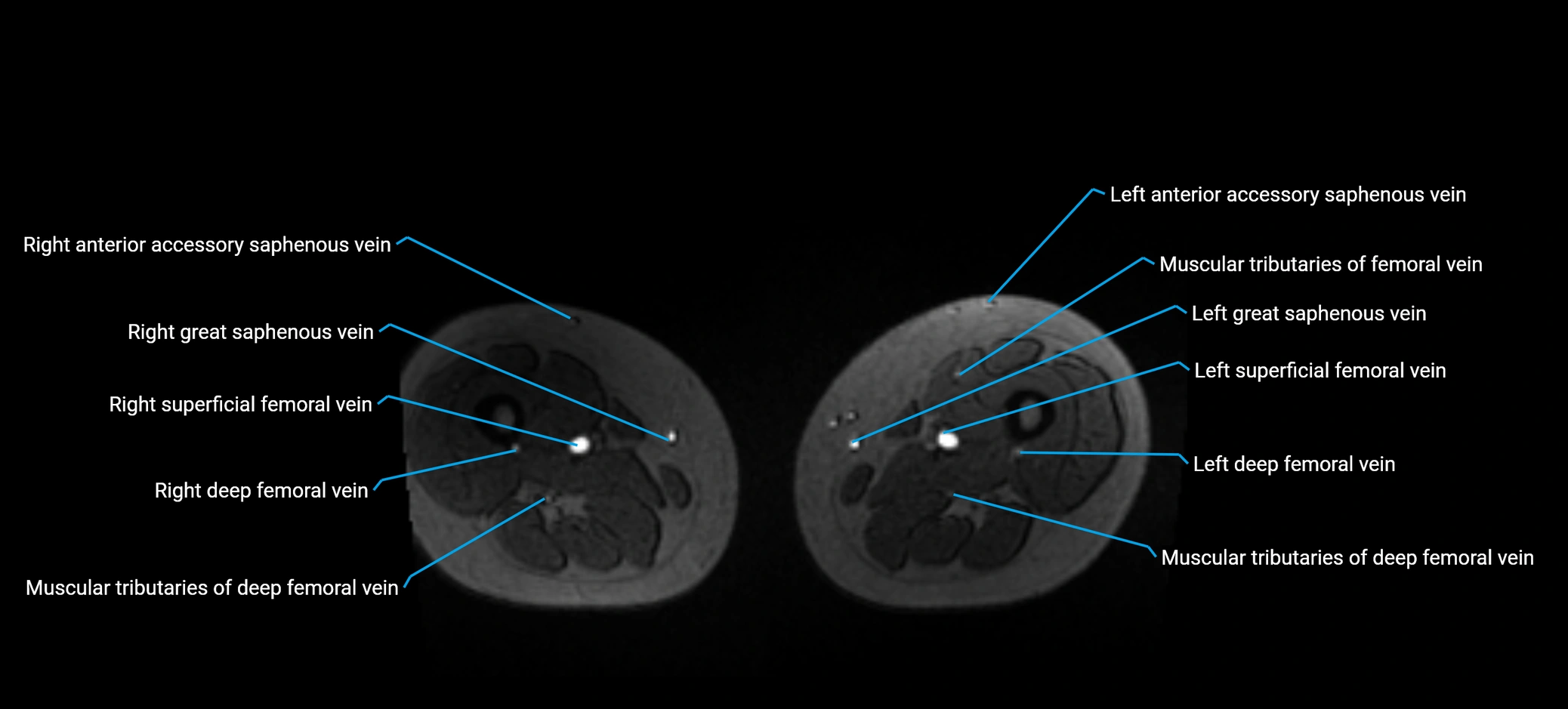 MRV abdomen pelvis & lower limb axial cross sectional anatomy labelled MRI image 286 (1).webp